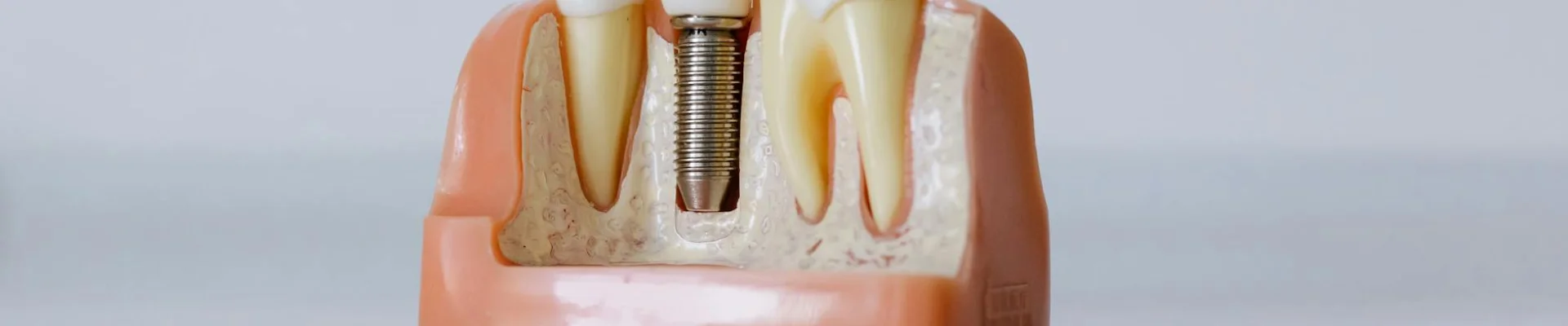 Estética dental, implantes y la promesa de resultado